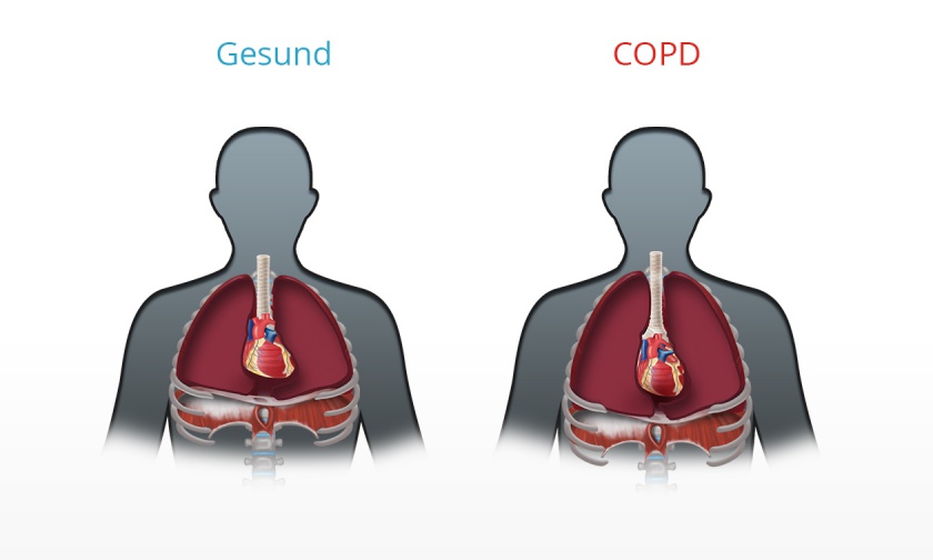 Konsequenzen der COPD - Überblähung